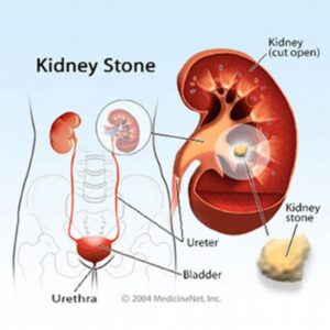 Kidney Stones