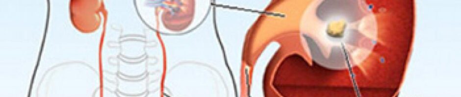 Kidney Stones
